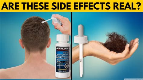 finasteride and minoxidil spray side effects